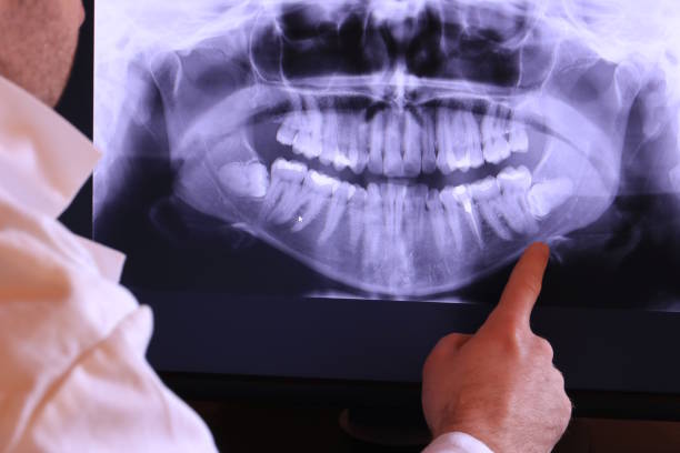 Best Emergency Wisdom Teeth Removal in Gainesboro, TN
